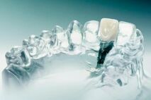 Implantat | Zahnarztpraxis Dr. Schuh in Konstanz