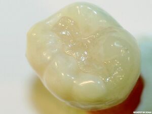 Cerec CAD-Keramikinlays | Zahnarztpraxis Dugar in Konstanz