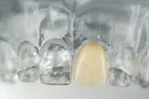 Veneers | Zahnarztpraxis Dugar in Konstanz