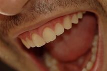 Bleaching | Zahnarztpraxis Dugar in Konstanz